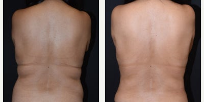 Tummy Tuck before and after photo