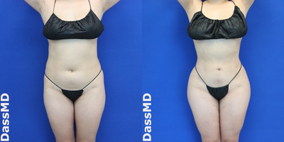 Brazilian Butt Lift before and after photo