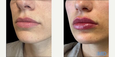 Dermal Fillers before and after photo