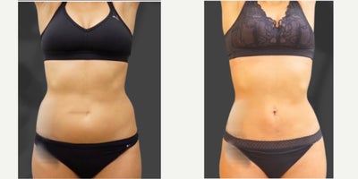 Liposuction before and after photo