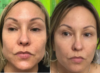 Botox before and after photo