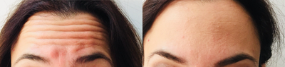 Botox before and after photo