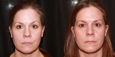 Botox before and after photo