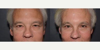 Eyelid Surgery before and after photo