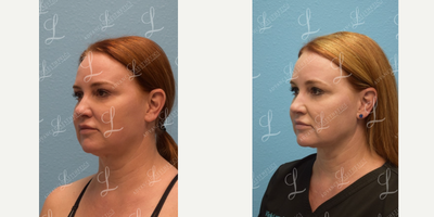 FaceTite before and after photo