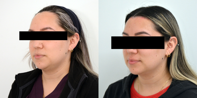 Forehead Reduction before and after photo