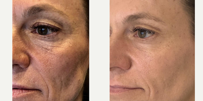 Liquid Facelift before and after photo