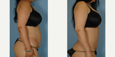 Tummy Tuck before and after photo