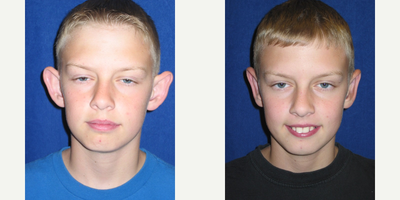 Ear Surgery before and after photo