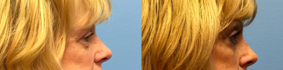 Eyelid Surgery before and after photo