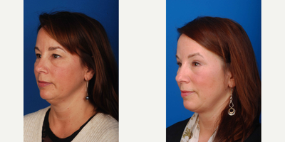 Facelift before and after photo