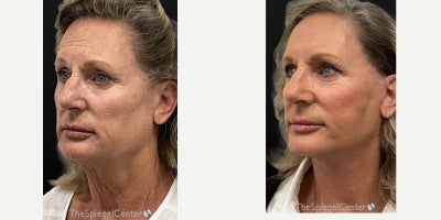 Facelift before and after photo