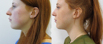 Rhinoplasty before and after photo
