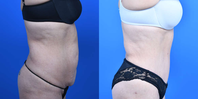 SAFELipo before and after photo
