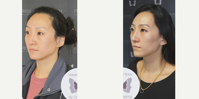 Botox before and after photo