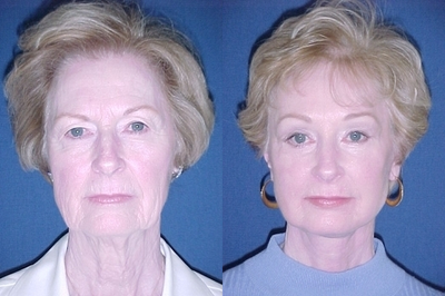 Facelift before and after photo