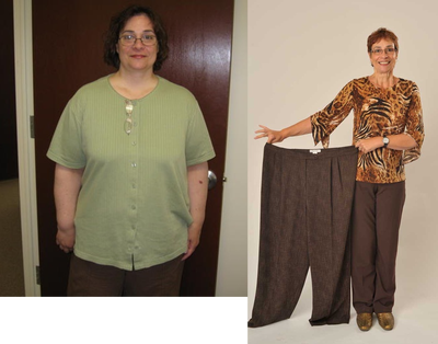 Gastric Bypass before and after photo