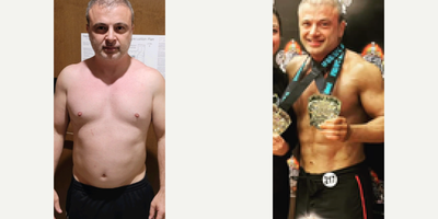 Liposuction before and after photo
