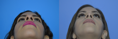 Rhinoplasty before and after photo