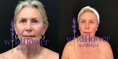 Skin Tightening before and after photo