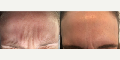 Botox before and after photo