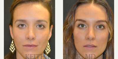 Brow Lift before and after photo