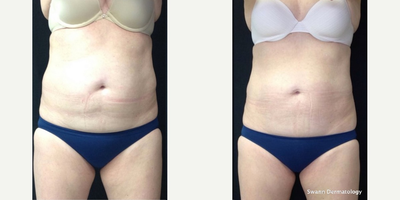CoolSculpting before and after photo