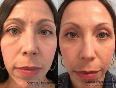 Dermal Fillers before and after photo