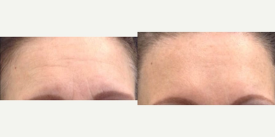 Dysport before and after photo