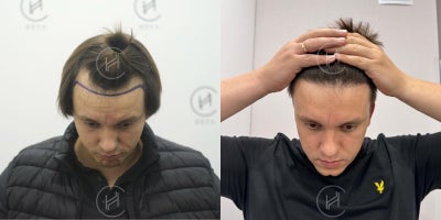 FUE Hair Transplant before and after photo