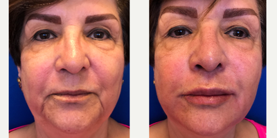 Radiesse before and after photo