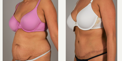 Tummy Tuck before and after photo