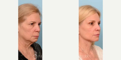 Facelift before and after photo