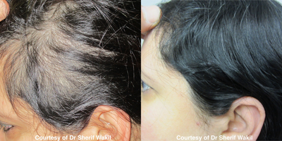 Hair Loss Treatment before and after photo