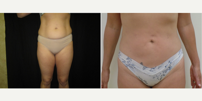 Liposuction before and after photo