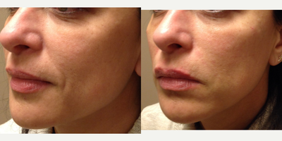 Liquid Facelift before and after photo