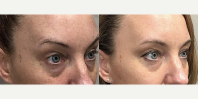 PRP Injections before and after photo