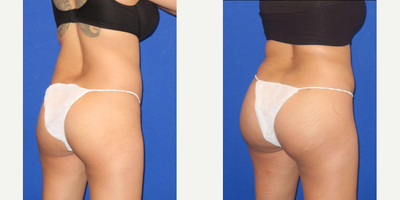 Brazilian Butt Lift before and after photo