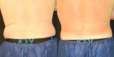 CoolSculpting before and after photo