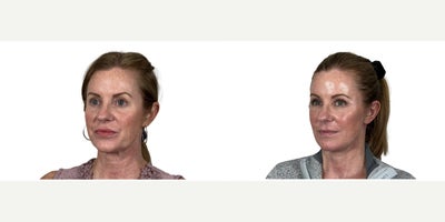 Facial Fat Transfer before and after photo