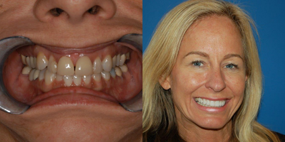 Porcelain Veneers before and after photo
