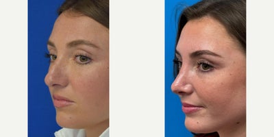 Revision Rhinoplasty before and after photo