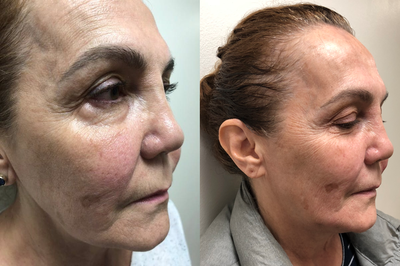 Skin Tightening before and after photo