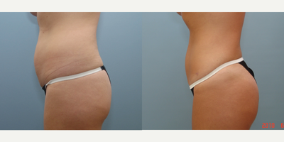 Smart Lipo before and after photo