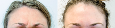 Botox before and after photo