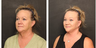 Facelift before and after photo