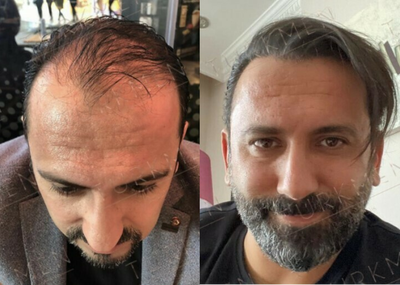 FUE Hair Transplant before and after photo