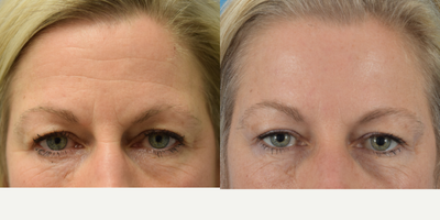 Botox before and after photo