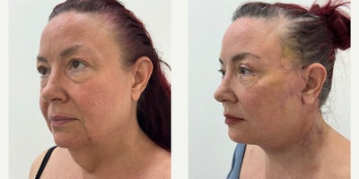 Deep Plane Facelift before and after photo