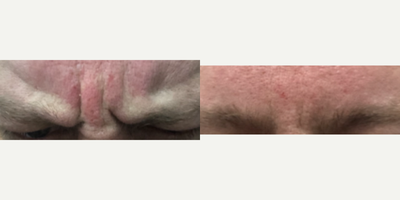 Dysport before and after photo